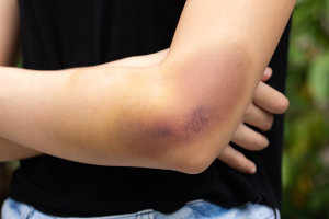 Assault occasioning actual bodily harm